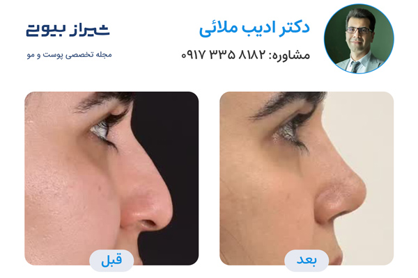 بهترین دکتر عمل بینی در شیراز - دکتر ادیب ملائی