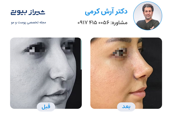 جراح بینی در شیراز - دکتر آرش کرمی