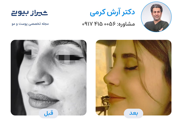 جراح بینی در شیراز - دکتر آرش کرمی