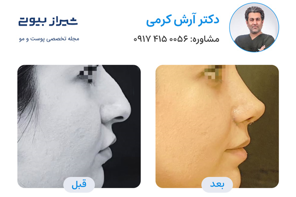 جراح بینی در شیراز - دکتر آرش کرمی