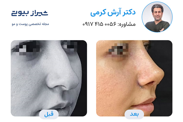 جراح بینی در شیراز - دکتر آرش کرمی