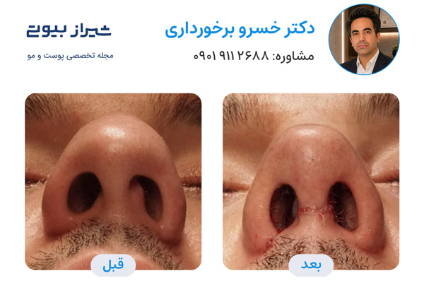 بهترین جراح بینی در شیراز - دکتر خسرو برخورداری