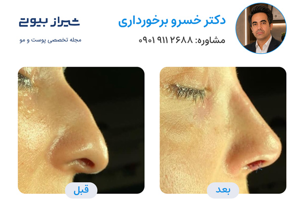 بهترین جراح بینی در شیراز - دکتر خسرو برخورداری