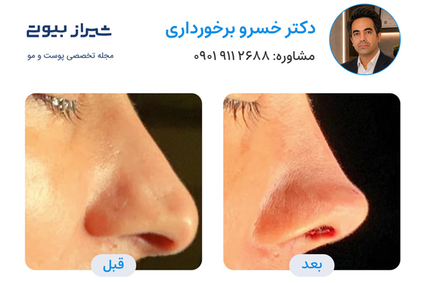 بهترین جراح بینی در شیراز - دکتر خسرو برخورداری