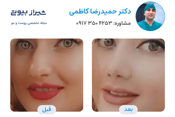 بهترین جراح بینی در شیراز - دکتر حمیدرضا کاظمی