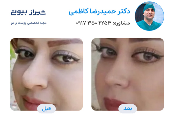 بهترین جراح بینی در شیراز - دکتر حمیدرضا کاظمی