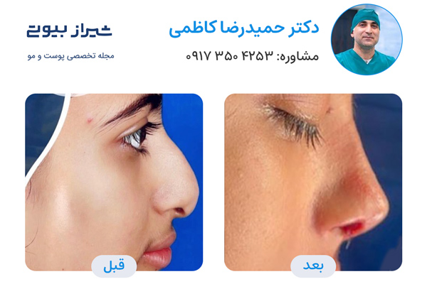 بهترین جراح بینی در شیراز - دکتر حمیدرضا کاظمی