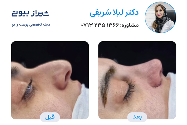 عمل بینی در شیراز - دکتر لیلا شریفی