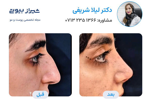 عمل بینی در شیراز - دکتر لیلا شریفی
