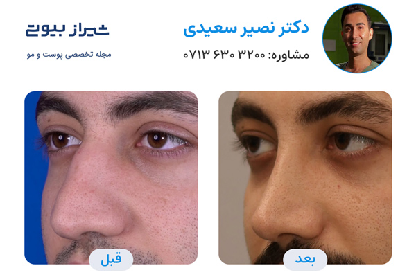 عمل بینی در شیراز - دکتر نصیر سعیدی