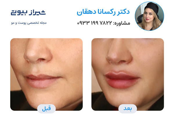 بهترین دکتر تزریق ژل لب در شیراز - دکتر رکسانا دهقانی