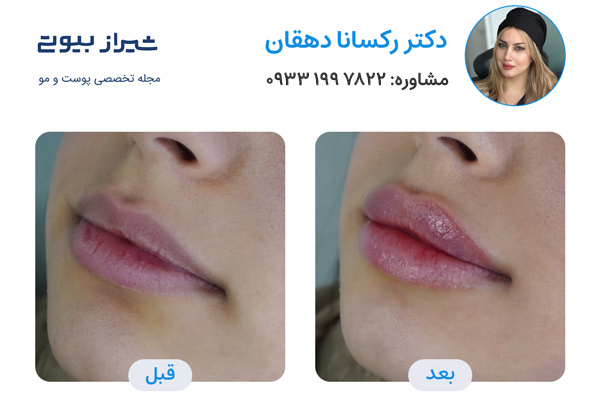 بهترین دکتر تزریق ژل لب در شیراز - دکتر رکسانا دهقانی