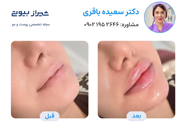 تزریق ژل لب در شیراز - دکتر سعیده باقری