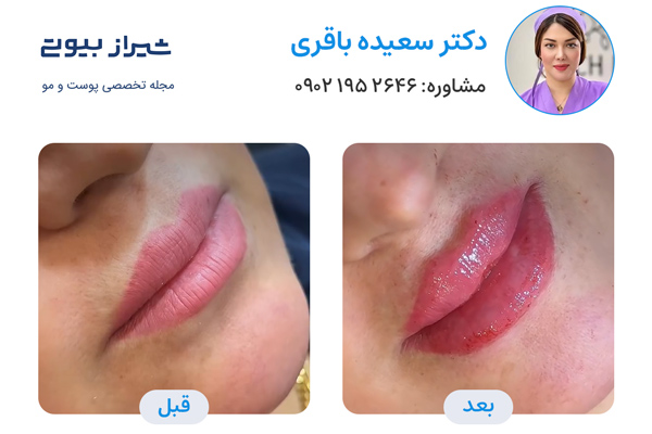 تزریق ژل لب در شیراز - دکتر سعیده باقری