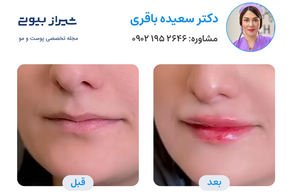 تزریق ژل لب در شیراز - دکتر سعیده باقری