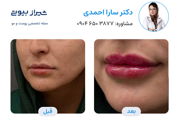 تزریق ژل لب در شیراز - دکتر سارا محمدی