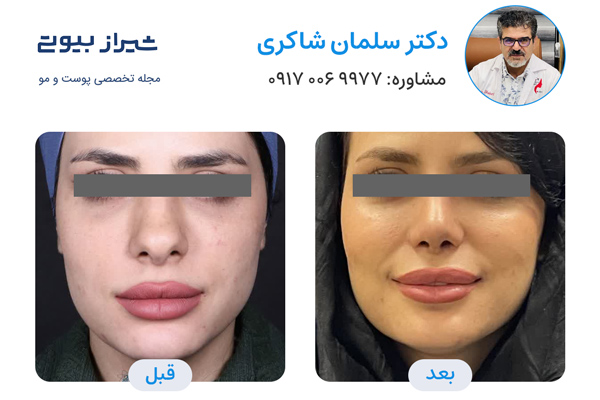 عمل بینی در شیراز - دکتر سلمان شاکری