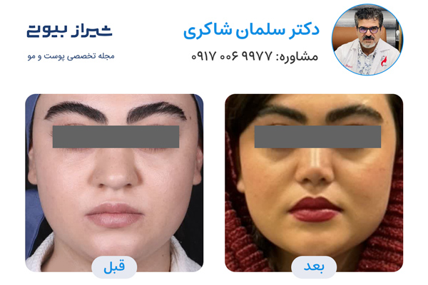 عمل بینی در شیراز - دکتر سلمان شاکری