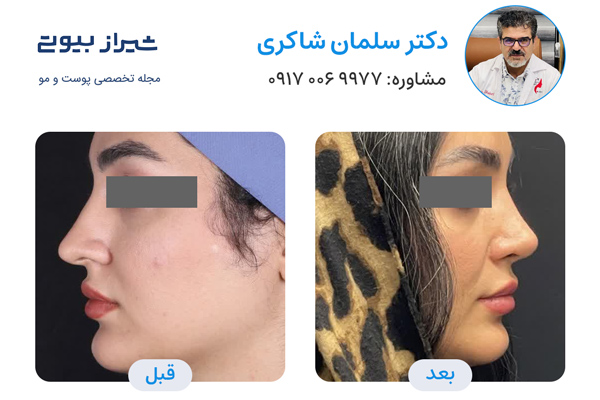 عمل بینی در شیراز - دکتر سلمان شاکری