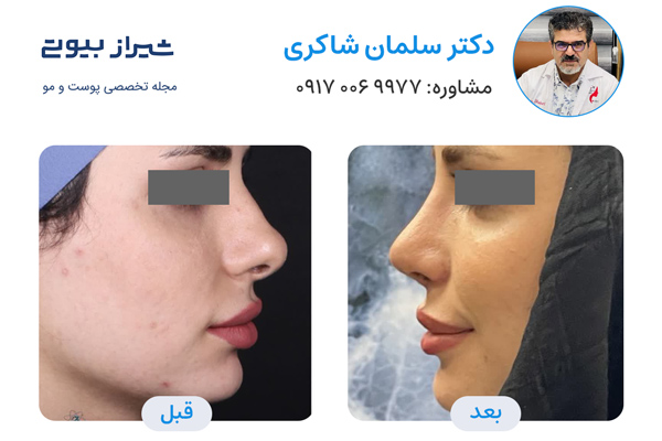 عمل بینی در شیراز - دکتر سلمان شاکری