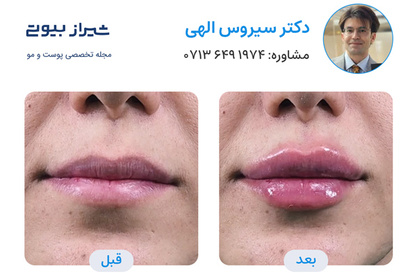 تزریق ژل لب در شیراز - دکتر سیروس الهی