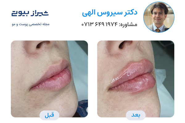 تزریق ژل لب در شیراز - دکتر سیروس الهی