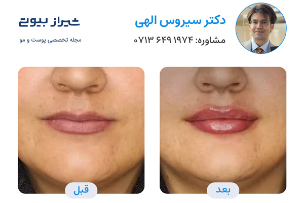 تزریق ژل لب در شیراز - دکتر سیروس الهی