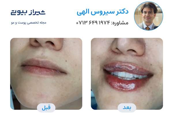 تزریق ژل لب در شیراز - دکتر سیروس الهی
