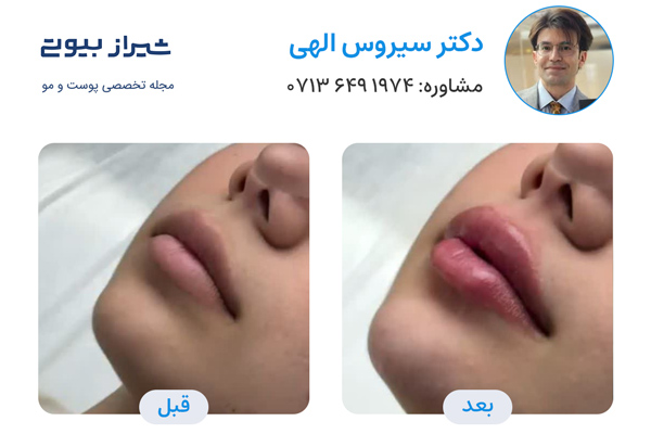 تزریق ژل لب در شیراز - دکتر سیروس الهی