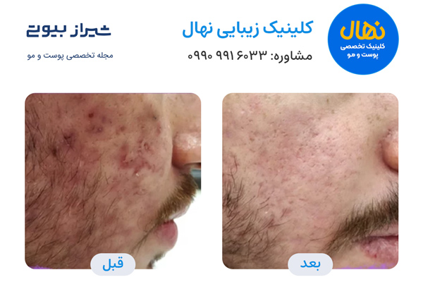 لیزر فرکشنال در شیراز - کلینیک نهال