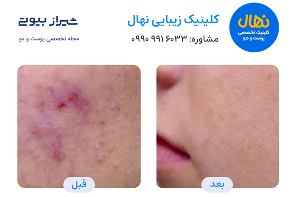 لیزر فرکشنال در شیراز - کلینیک نهال