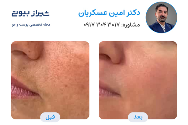 لیزر فرکشنال در شیراز - دکتر امین عسکریان