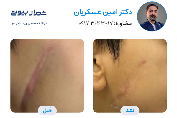 لیزر فرکشنال در شیراز - دکتر امین عسکریان