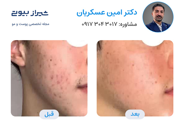 لیزر فرکشنال در شیراز - دکتر امین عسکریان