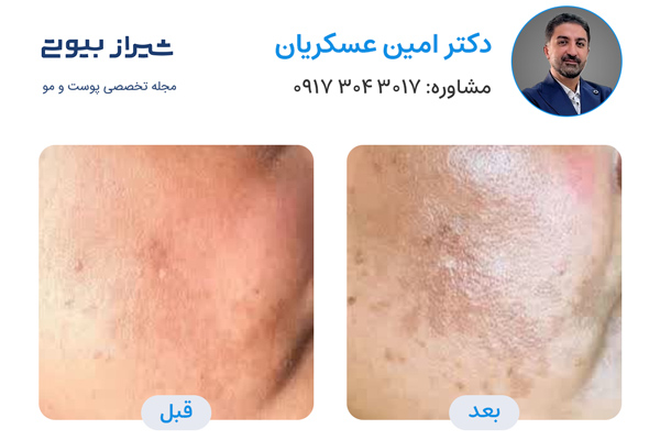 لیزر فرکشنال در شیراز - دکتر امین عسکریان