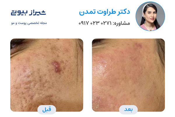 لیزر فرکشنال در شیراز - دکتر طراوت تمدن