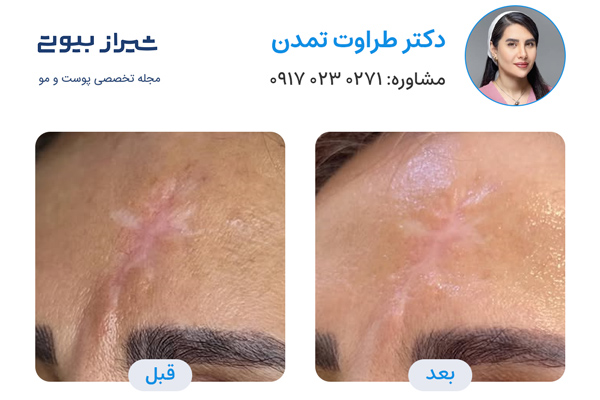 لیزر فرکشنال در شیراز - دکتر طراوت تمدن