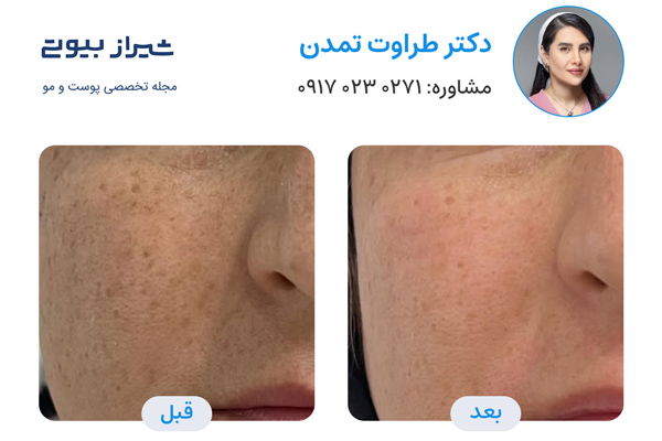 لیزر فرکشنال در شیراز - دکتر طراوت تمدن