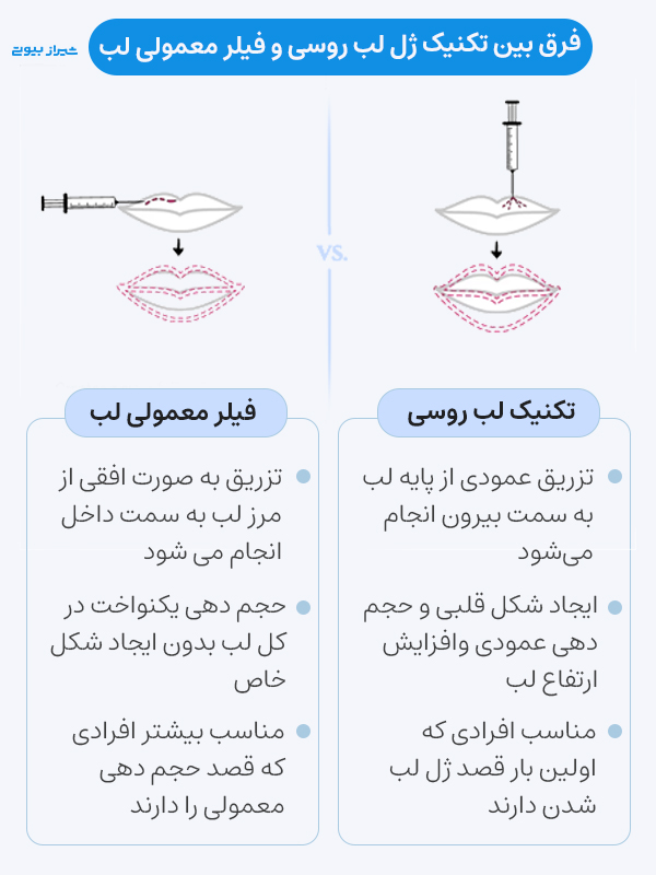 تفاوت‌های اصلی تکنیک ژل لب روسی با روش‌ معمولی