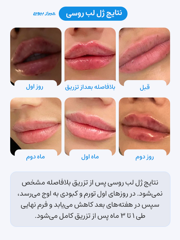 نتایج ژل لب روسی