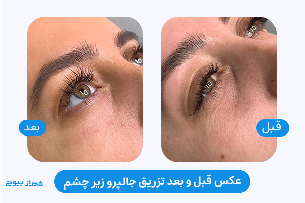 عکس قبل و بعد تزریق مزوژل جالپرو زیر چشم در شیراز