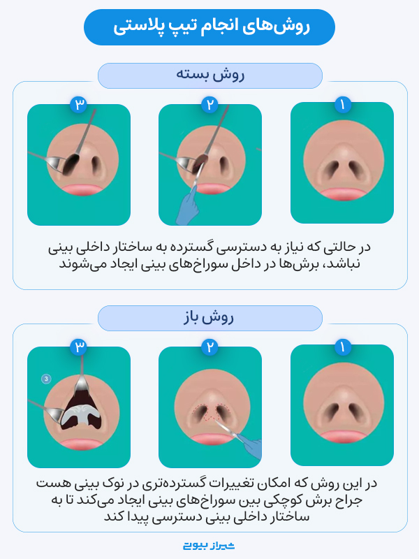 روند انجام تیپ رینوپلاستی