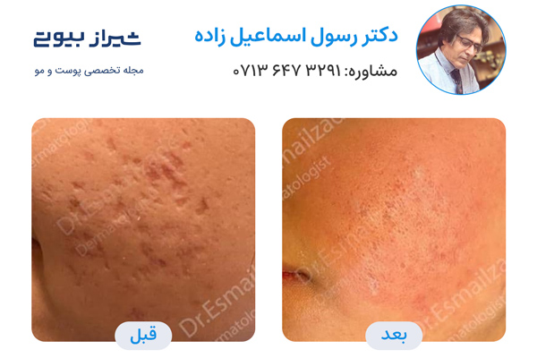 درمان اسکار در شیراز - دکتر رسول اسماعیل زاده