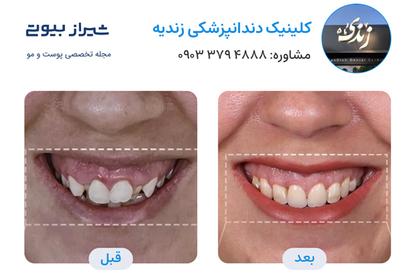 ارتودنسی دندان در شیراز - کلینیک دندانپزشکی زندیه