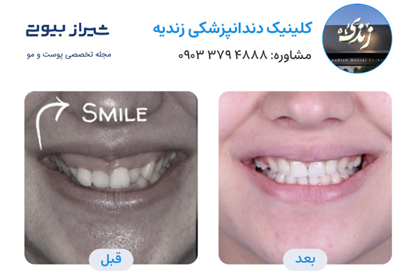 ارتودنسی دندان در شیراز - کلینیک دندانپزشکی زندیه
