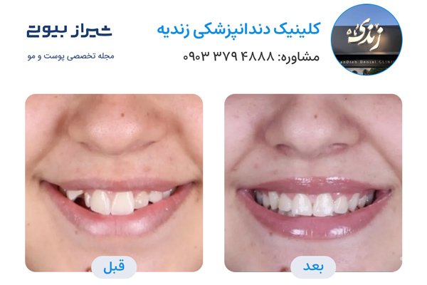 ارتودنسی دندان در شیراز - کلینیک دندانپزشکی زندیه
