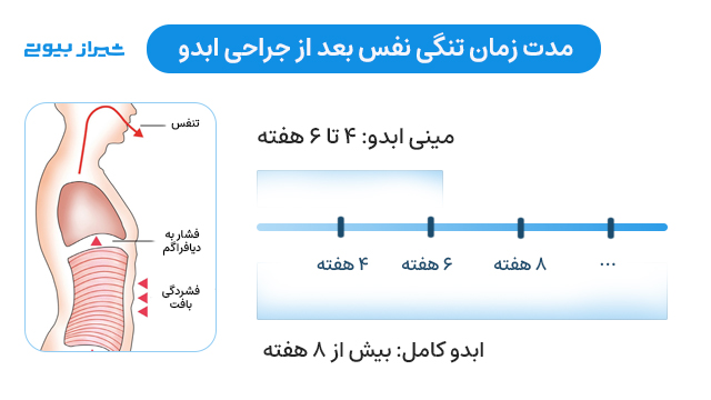 مدت زمان تنگی نفس بعد از جراحی ابدومینوپلاستی