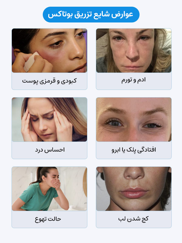 عوارض شایع تزریق بوتاکس