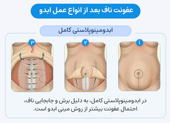 مقایسه عفونت ناف بعد از انواع عمل ابدومینوپلاستی