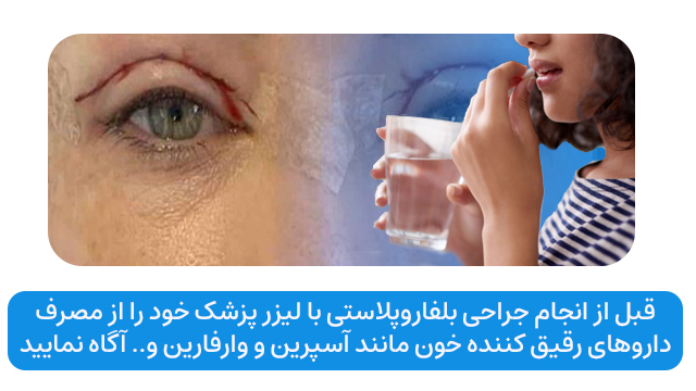 قبل از انجام جراحی بلفاروپلاستی با لیزر پزشک خود را از مصرف داروهای رقیق کننده خون مانند آسپرین و وارفارین و.. آگاه نمایید.